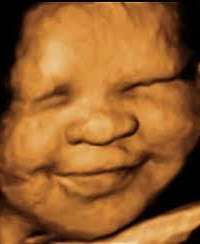 3D ultrasound