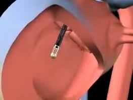 Impella