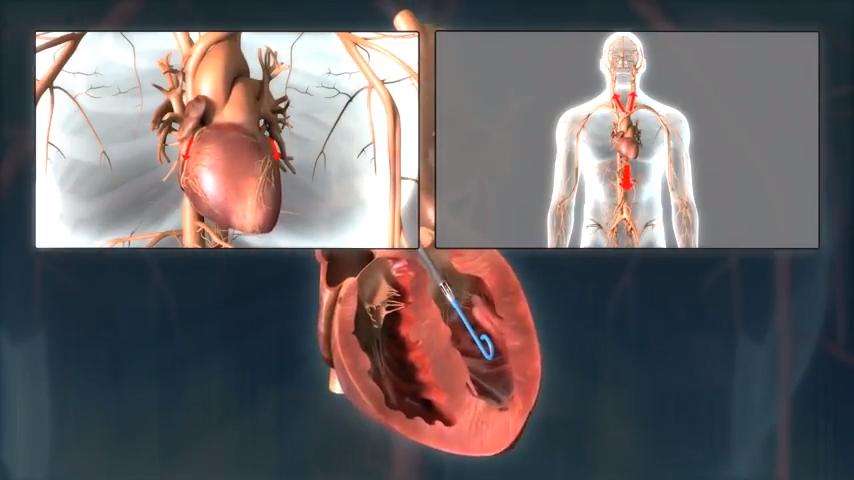 Impella in heart