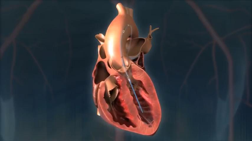 Impella Heart Pump: What the Tiny Heart Support Device Does - Cover Image