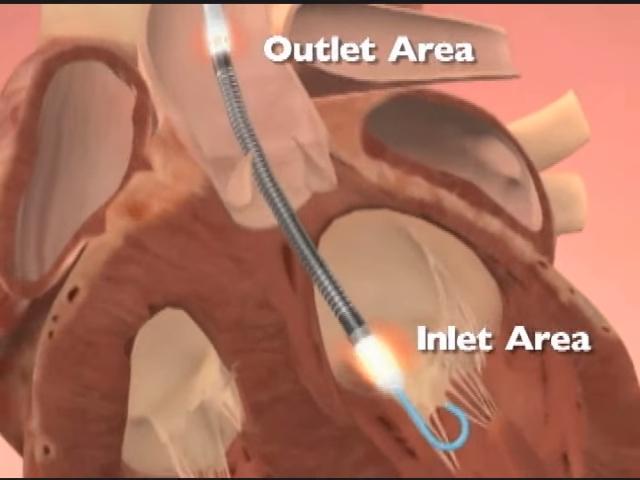 Structure of Impella